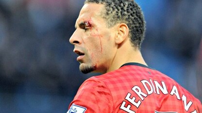 il giocatore colpito all'occhio dalla monetina