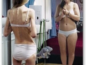 anoressia
