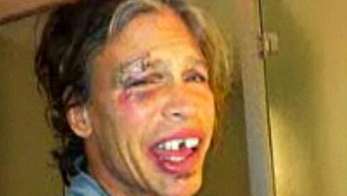 Steven Tyler casca dalla doccia a seguito di un malore: un taglio al sopracciglio, ferite alla bocca e due denti rotti.