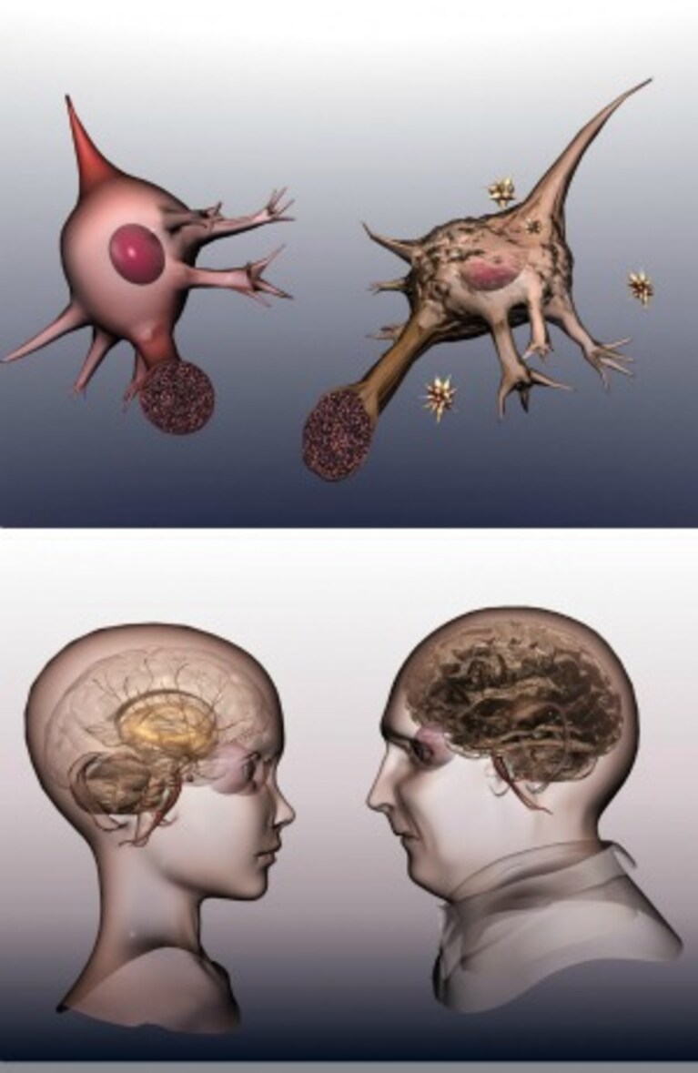 morbo di alzheimer