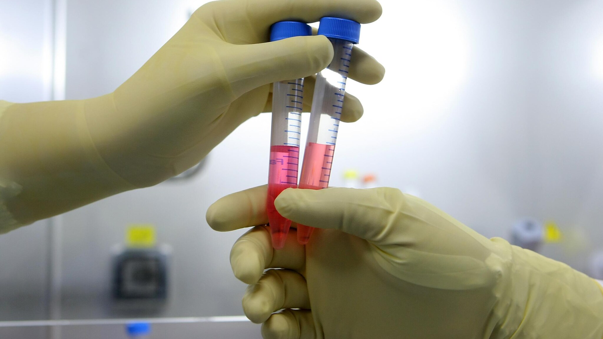 La decisione definitiva del tribunale di Venezia per la piccola di due anni malata di atrofia muscolare spinale: potrà essere curata con le cellule staminali a Brescia. La sua famiglia ha accolto con soddisfazione la sentenza.