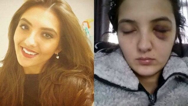 Anastasia Frances prima e dopo l'aggressione (Facebook).