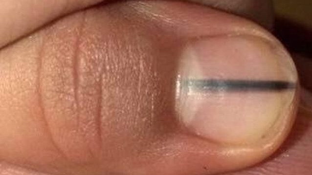La riga nera sotto l'unghia della paziente (Facebook).