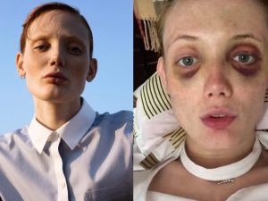 Kira Dice, prima e dopo l'aggressione (Facebook).