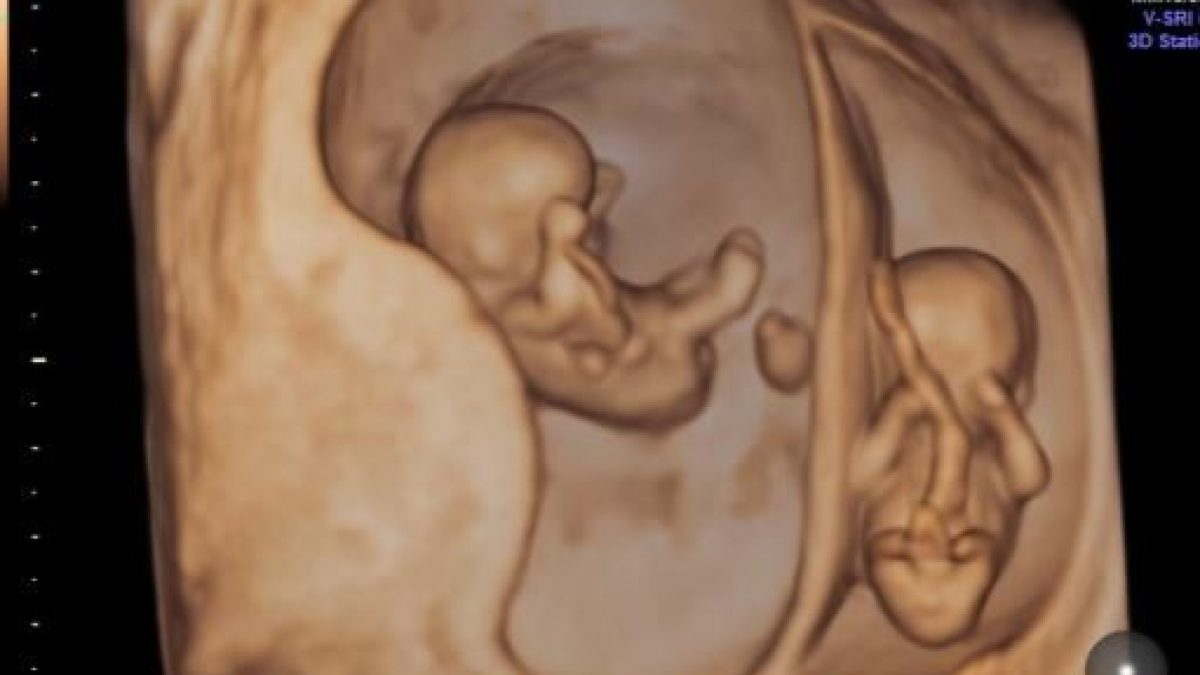 Brindisi, feto gemellare resta per 13