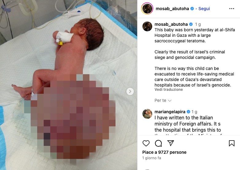 Il medico che ha curato la bimba arrivata da Gaza a Firenze con tumore di 1,5 chili: “Mai vista una massa così"