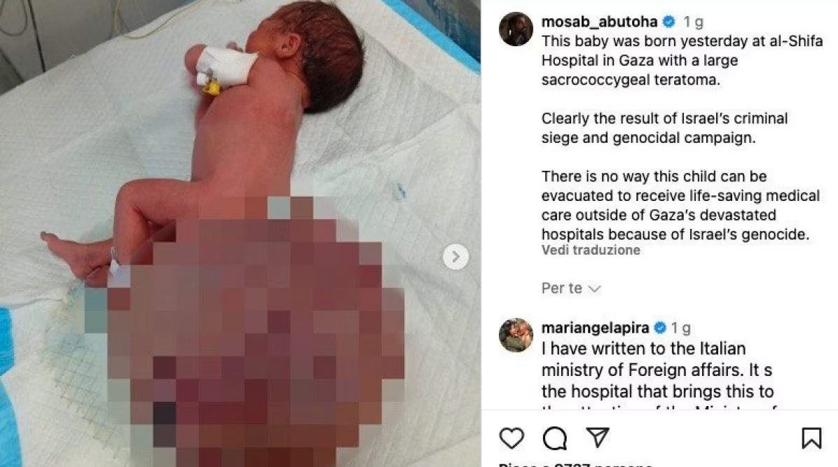 Neonata arrivata da Gaza operata al Meyer di Firenze: asportato tumore pesante 3 volte più del suo corpo