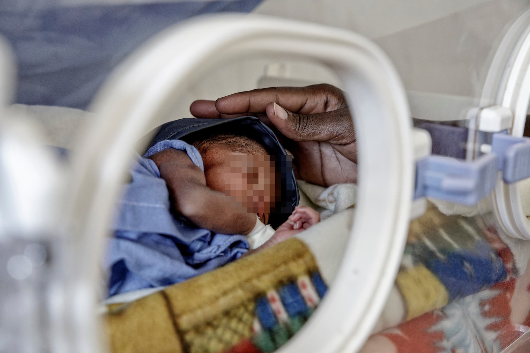 Uno dei piccoli pazienti di Kalongo – Foto Fondazione Ambrosoli.
