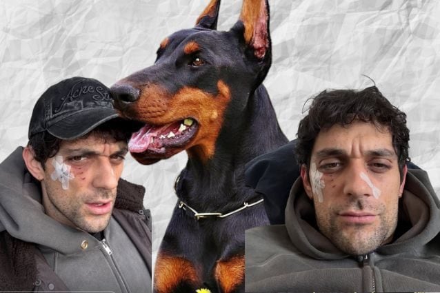 Bresh aggredito da un dobermann: come sta il cantante che posta le foto delle ferite al volto