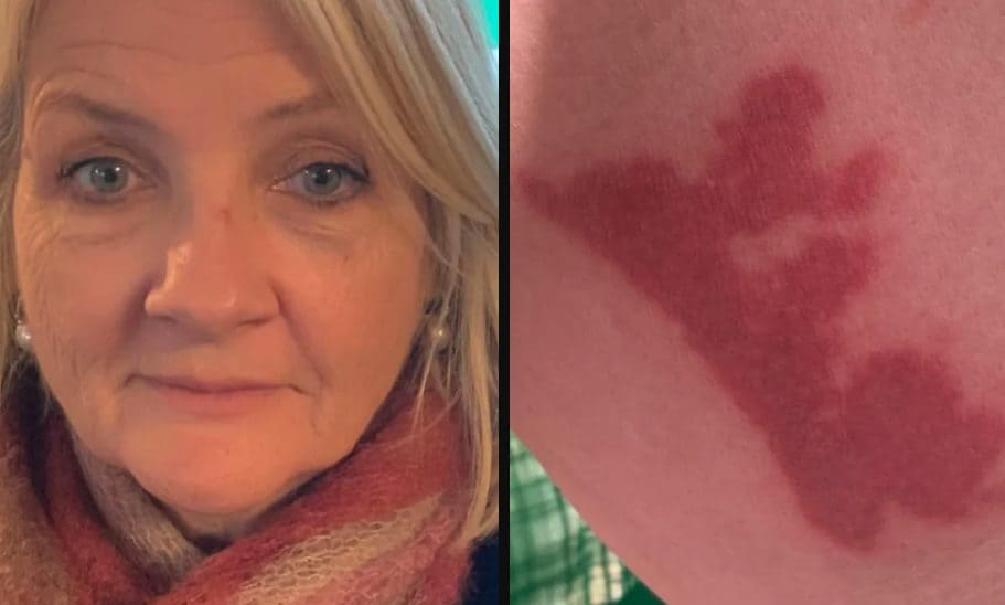 Il caffè sul volo Ryanair le finisce addosso: ci mette 8 mesi per guarire e ottiene maxi risarcimento