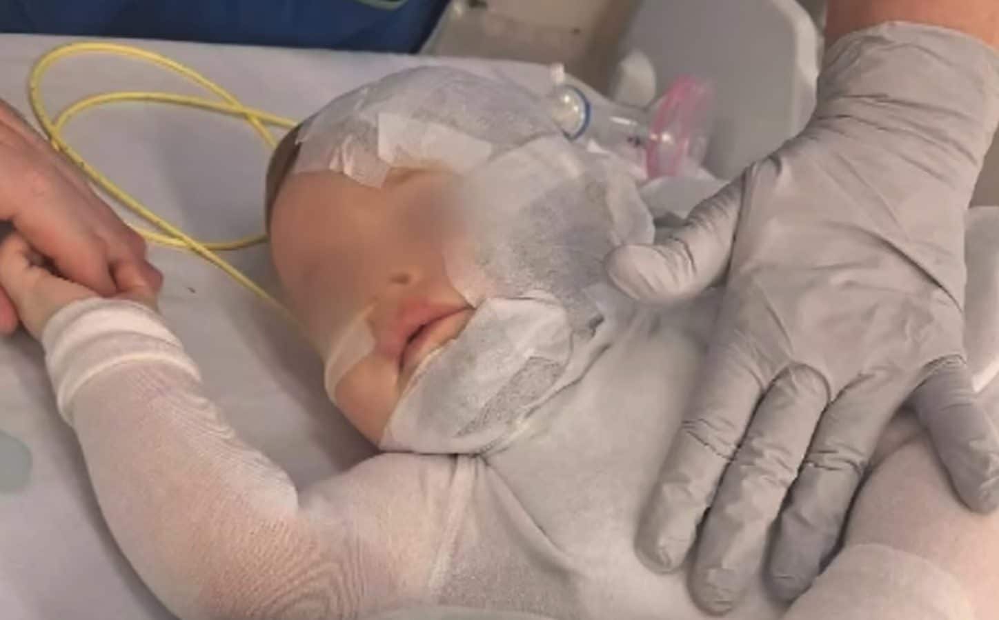 Rovescia un thermos di caffè bollente addosso a un neonato e fugge: il piccolo sottoposto a 8 operazioni