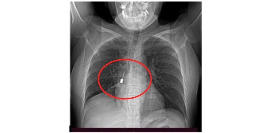 Al pronto soccorso con tosse e dolore toracico, aveva cacciavite odontoiatrico incastrato in un bronco