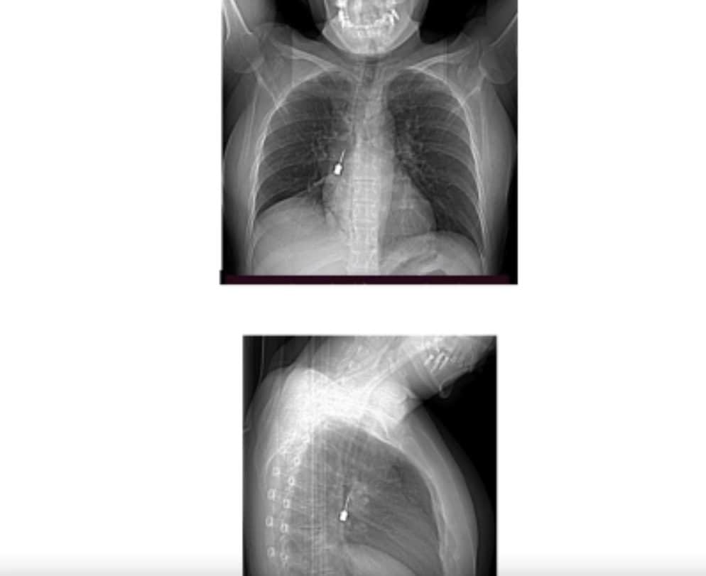 La Tac della paziente con il corpo estraneo