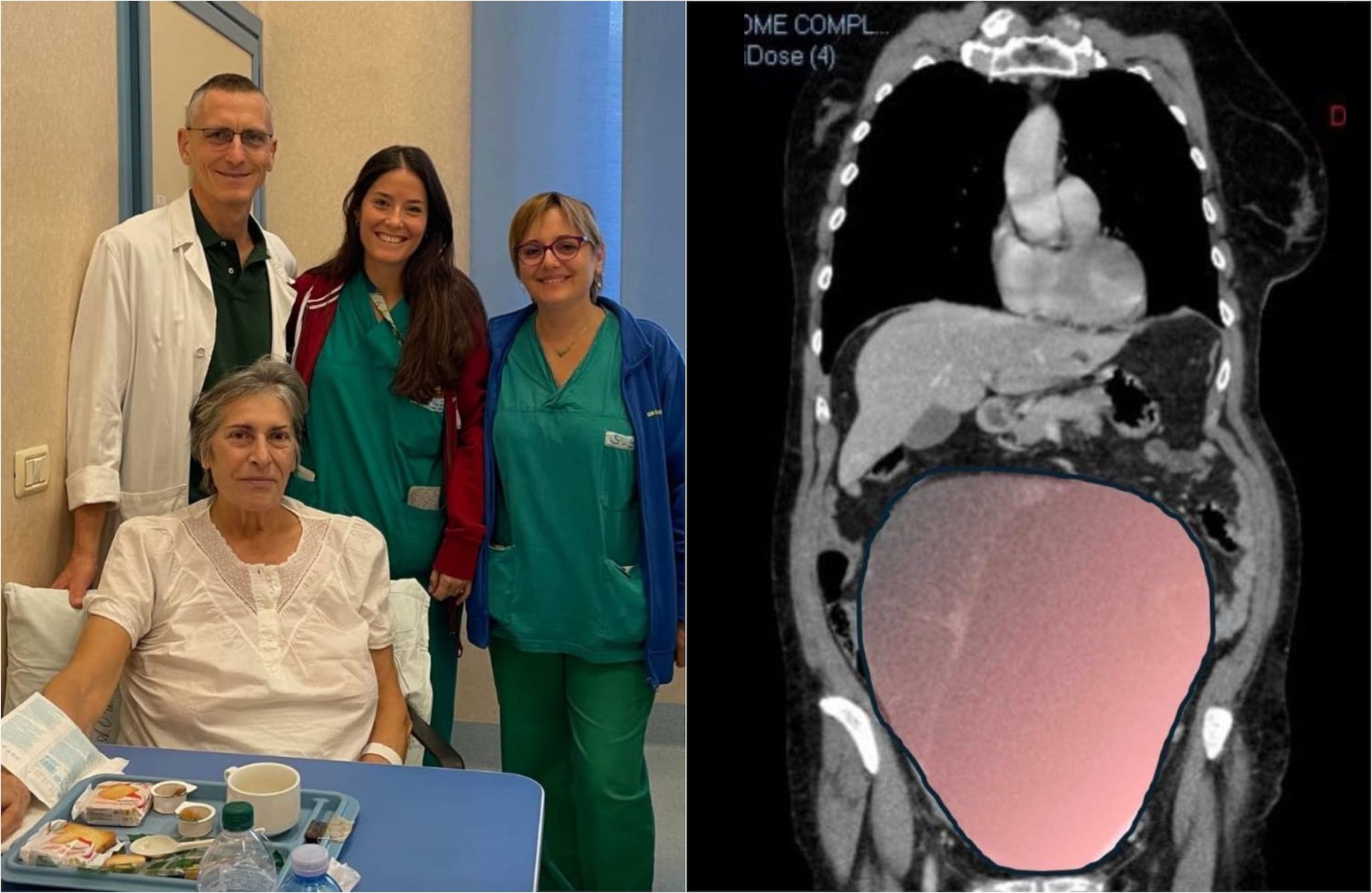 Intervento record a Torino, asportato tumore ovarico di 6 chili: "Era grande come una gravidanza gemellare"