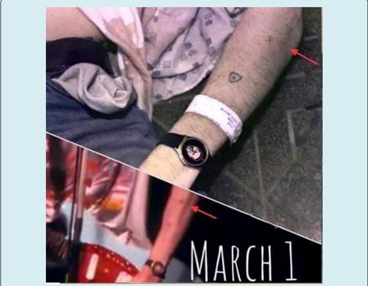 Foro sull’avambraccio, via studio