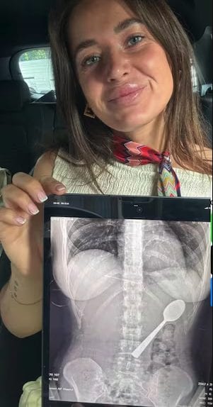 Reymy mostra il cucchiaio nella radiografia