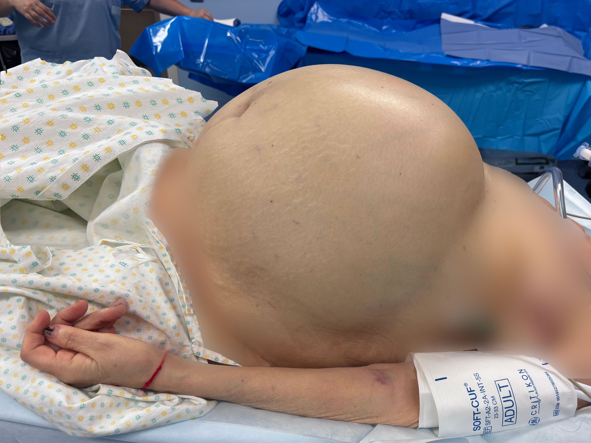 In pronto soccorso con enorme gonfiore alla pancia, scopre cisti ovarica da 50 kg: intervento record a Verona