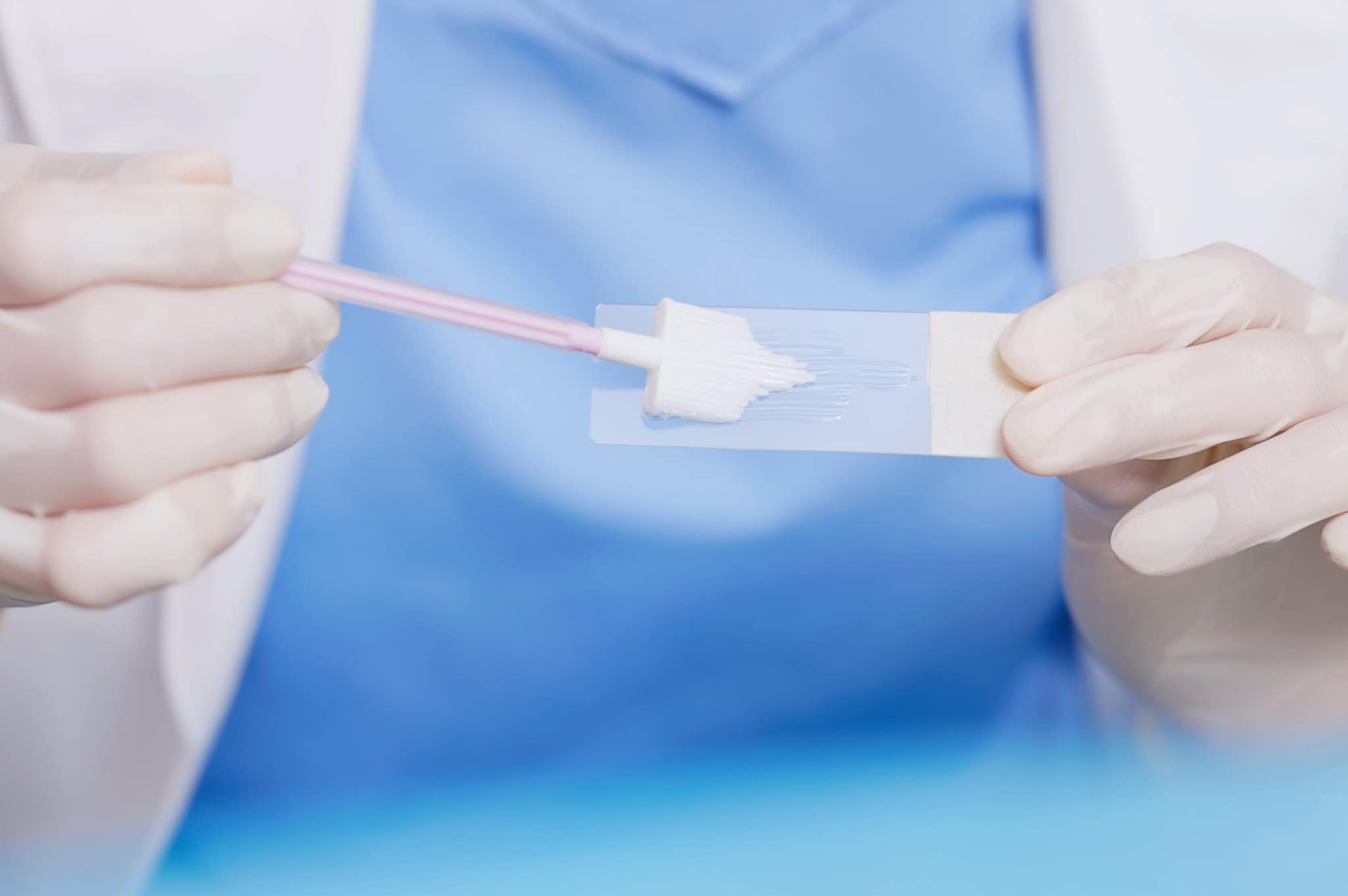 Svolge 3 pap test negativi, ma aveva un tumore all'utero: laboratorio risarcisce familiari per 300mila euro