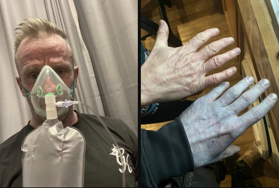 Va a dormire e si sveglia di colore blu, poi la corsa in ospedale. I medici: "La colpa è delle lenzuola"