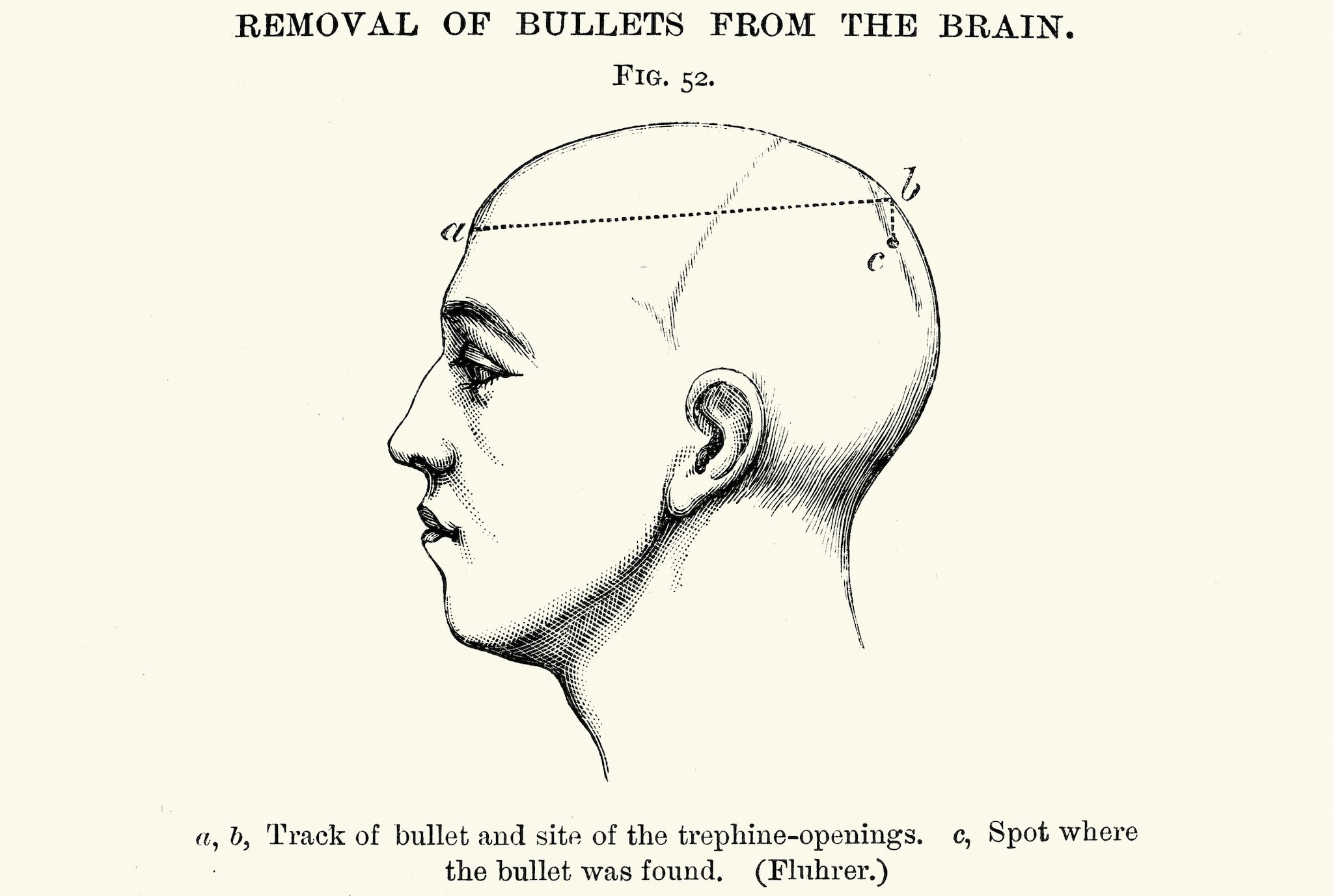 Palermo, 17enne va al pronto soccorso lamentando mal di testa, gli trovano un proiettile nel cranio