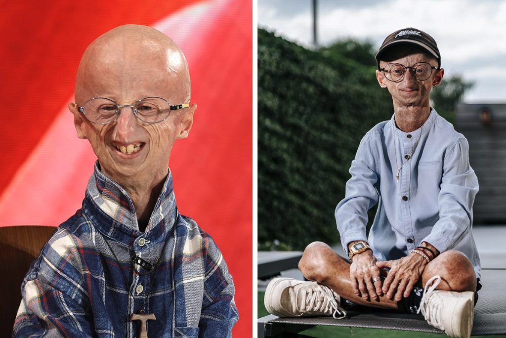 Addio Michiel Vandeweert, aveva la progeria: è morto a 28 anni, come l'italiano Sammy Basso