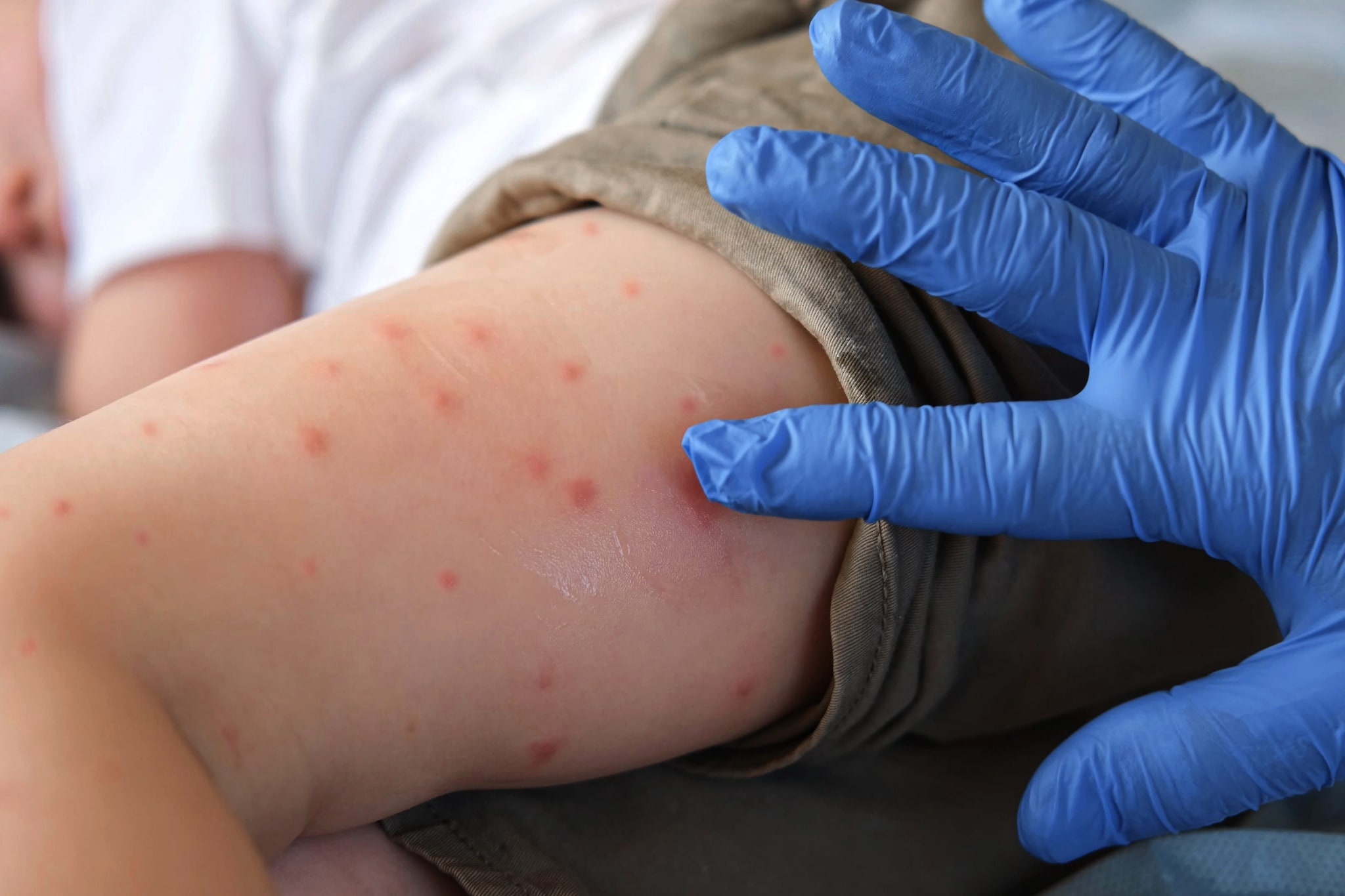 Chikungunya, caso confermato a Pisa: scatta la disinfestazione contro la zanzara tigre