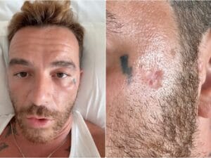 Il cantante Salmo annuncia di avere un carcinoma basocellulare