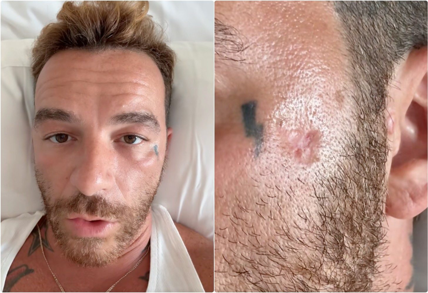 Salmo: "Ho un cancro della pelle" e scatena il dibattito sull'uso delle protezioni solari. L'ISS: "Fake news"