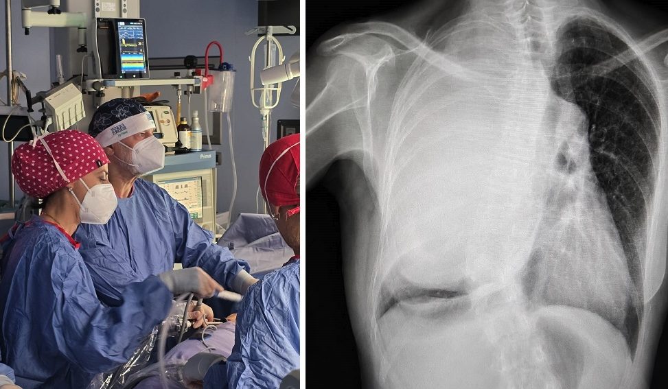 Pensava di avere la scoliosi, ma era un raro tumore di 3.5 kg: rimosso dopo 9 ore di intervento a Bari