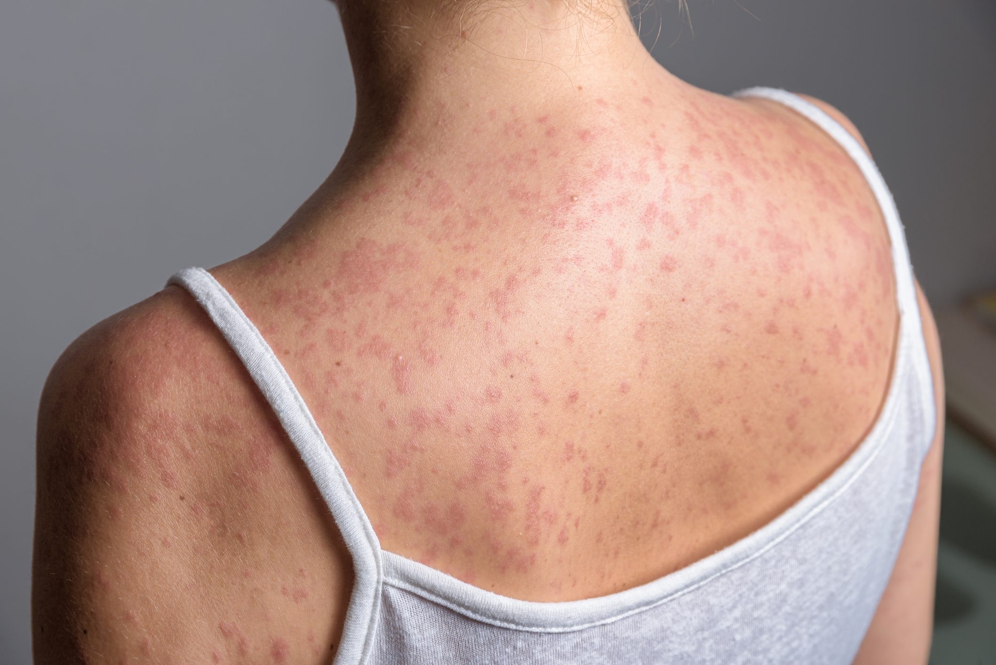 Morbillo, allarme negli Usa: New York dichiara l'emergenza, quasi 3.900 casi nel 2026