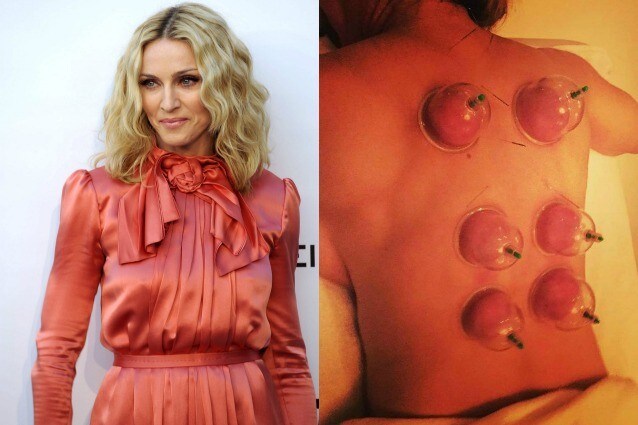 Madonna si tiene in forma con la “cupping therapy”: ecco come funziona