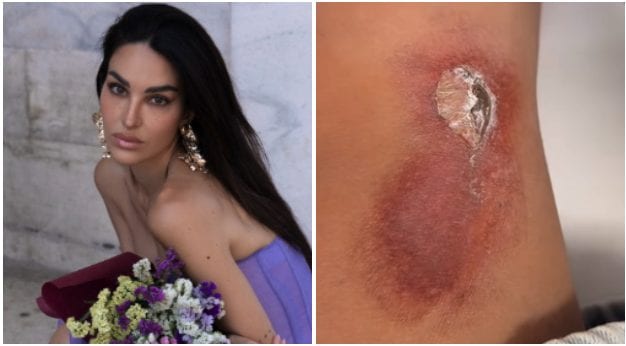 Rosa Perrotta si infortuna, cosa le è successo e come sta ora: "Ho preso una super botta"