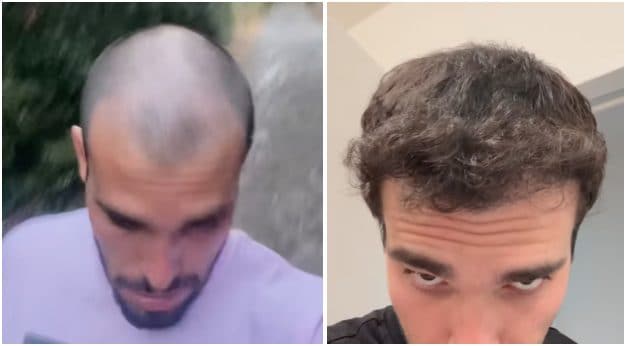 Il prima e dopo di Goffredo Cerza dopo il trapianto di capelli