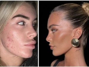 Sophie Codegoni ha rimosso il filler alle labbra: &#8220;Brucia tantissimo, non le toccherò mai più&#8221;