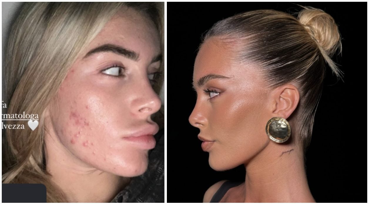 Sophie Codegoni ha rimosso il filler alle labbra: "Brucia tantissimo, non le toccherò mai più"