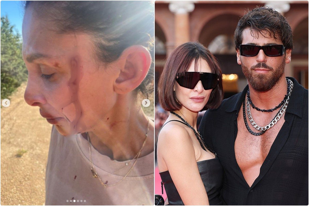 Sara Bluma rivela le foto delle violenze domestiche, il fidanzato Can Yaman: "Ti sosterrò. Non ha tradito l'ex con me"