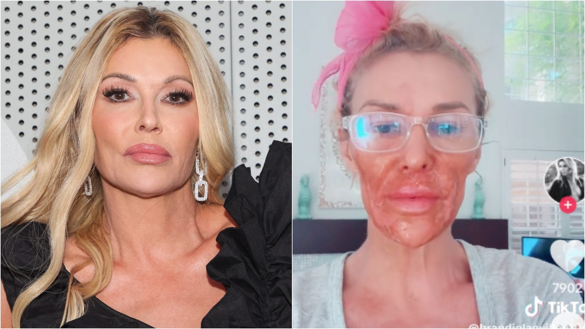 Brandi Glanville di The Real Housewifes sfigurata, ha usato la crema depilatoria per uccidere un parassita sul viso