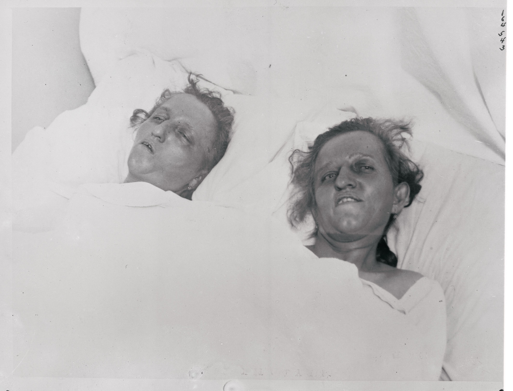 Le gemelle pochi giorni prima della morte avvenuta nel 1922, avevano 43 anni