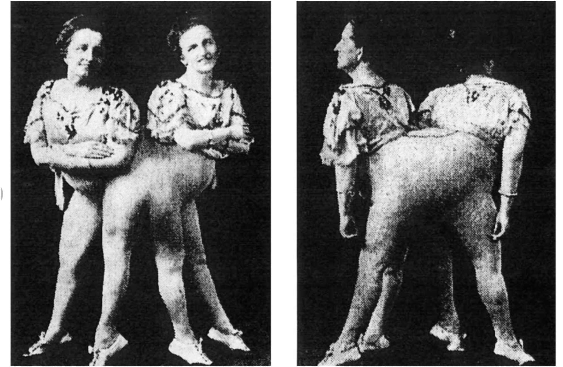 Una foto della morfologia corporea delle gemelle siamesi Rosa e Josepha Blažek tratta da un articolo scientifico pubblicato su ResearchGate