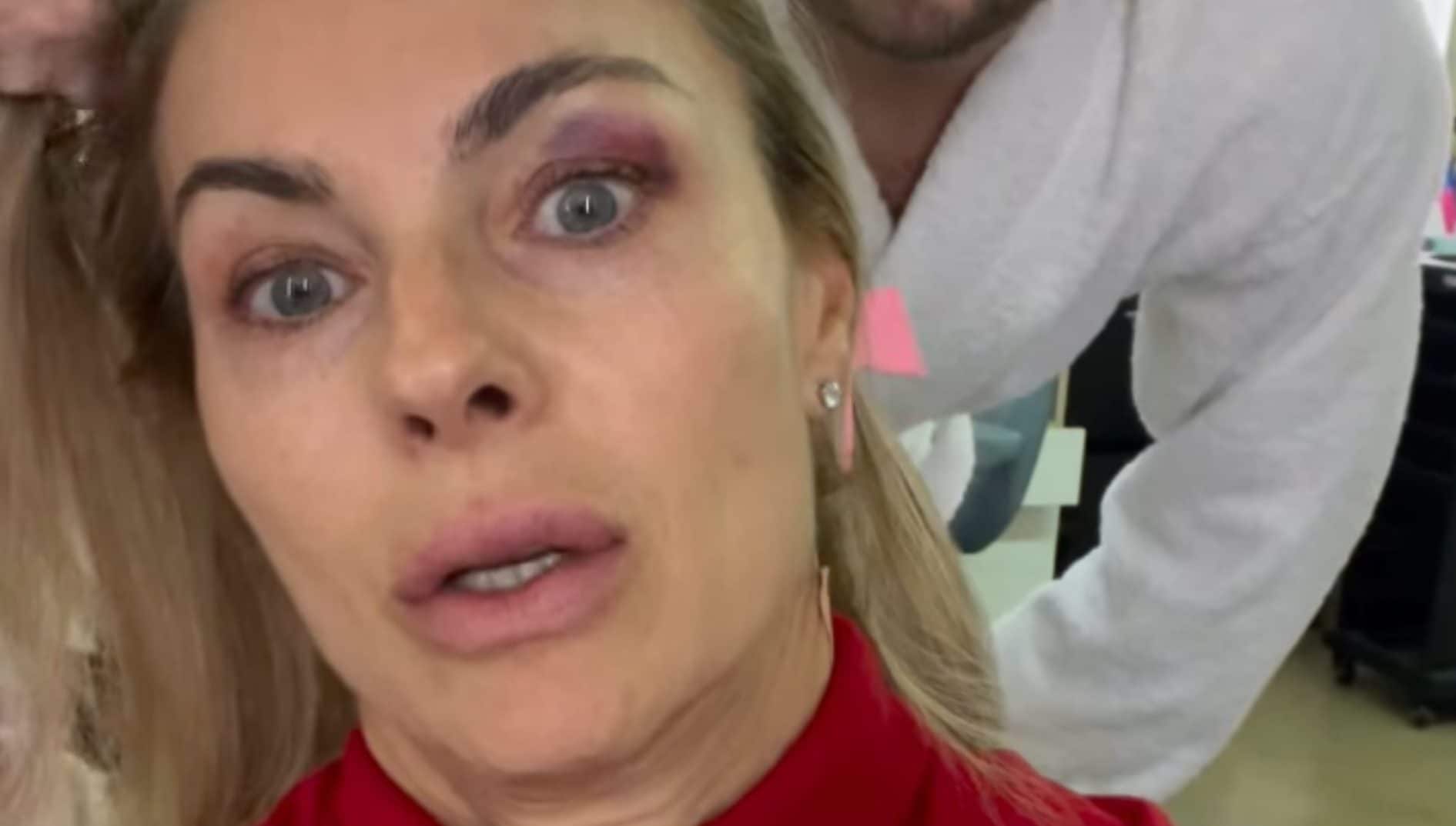 Martina Colombari con un livido sull'occhio prima della semifinale di Ballando: cosa è successo in sala prove