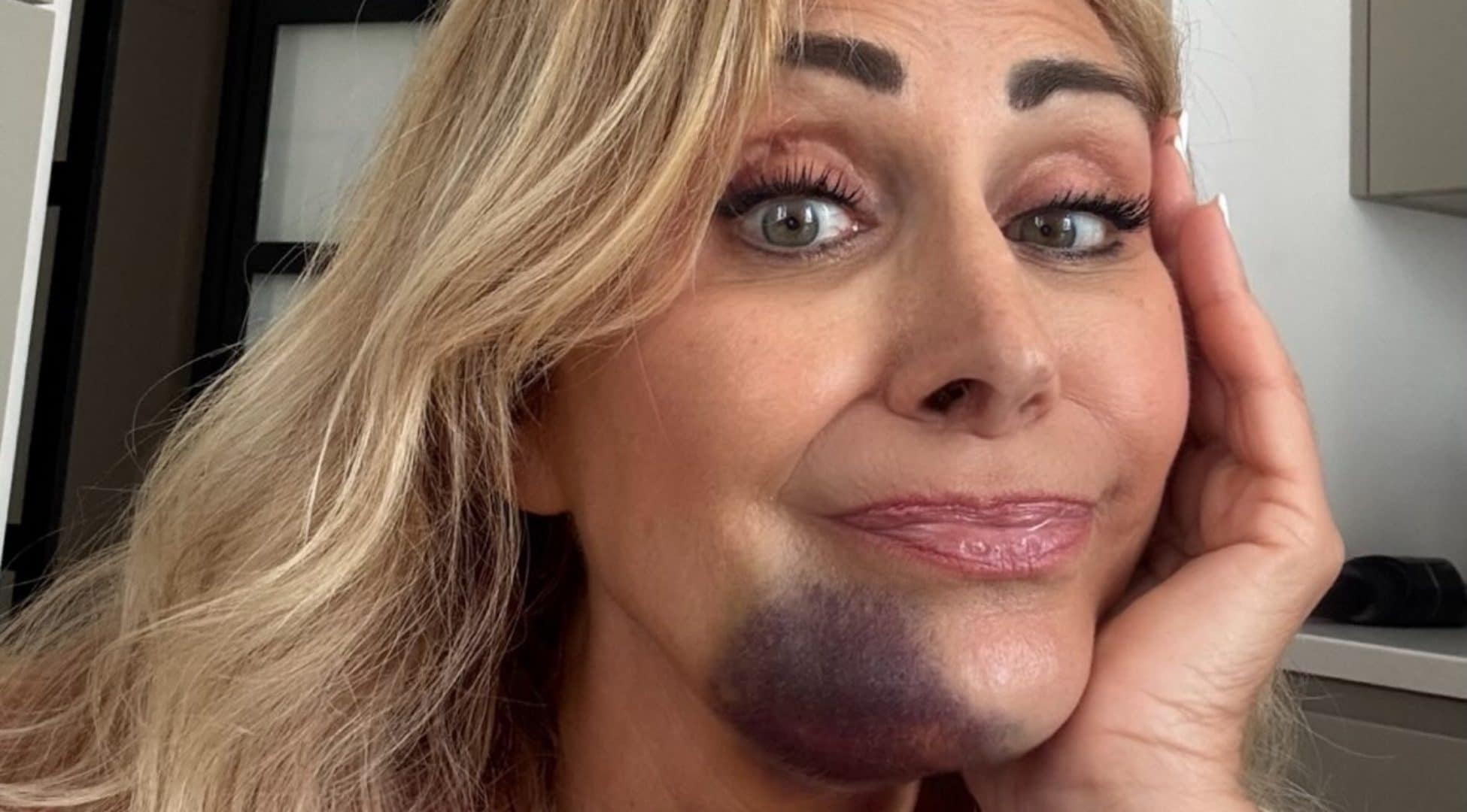 Paura per Marina Di Guardo: la madre di Chiara Ferragni, vittima di un incidente, mostra un vistoso livido sul viso