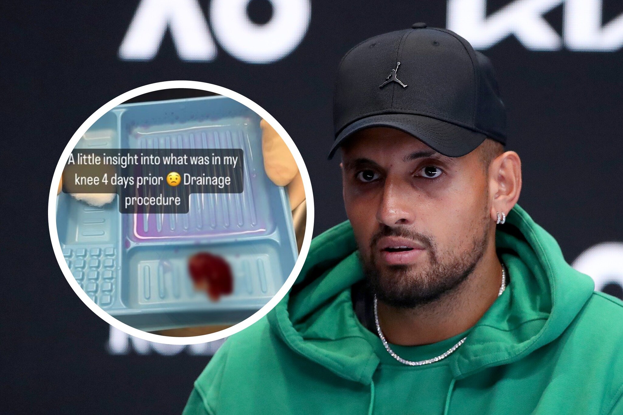 Kyrgios si ritira dagli Australian Open "Vi mostro cosa hanno trovato