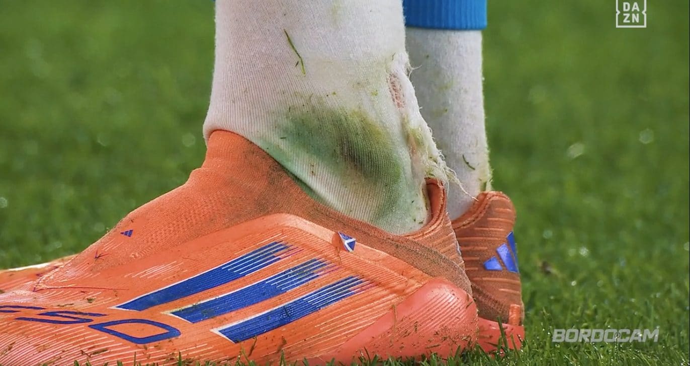 Il calzettone di McTominay lacerato dai tacchetti di Cristante.