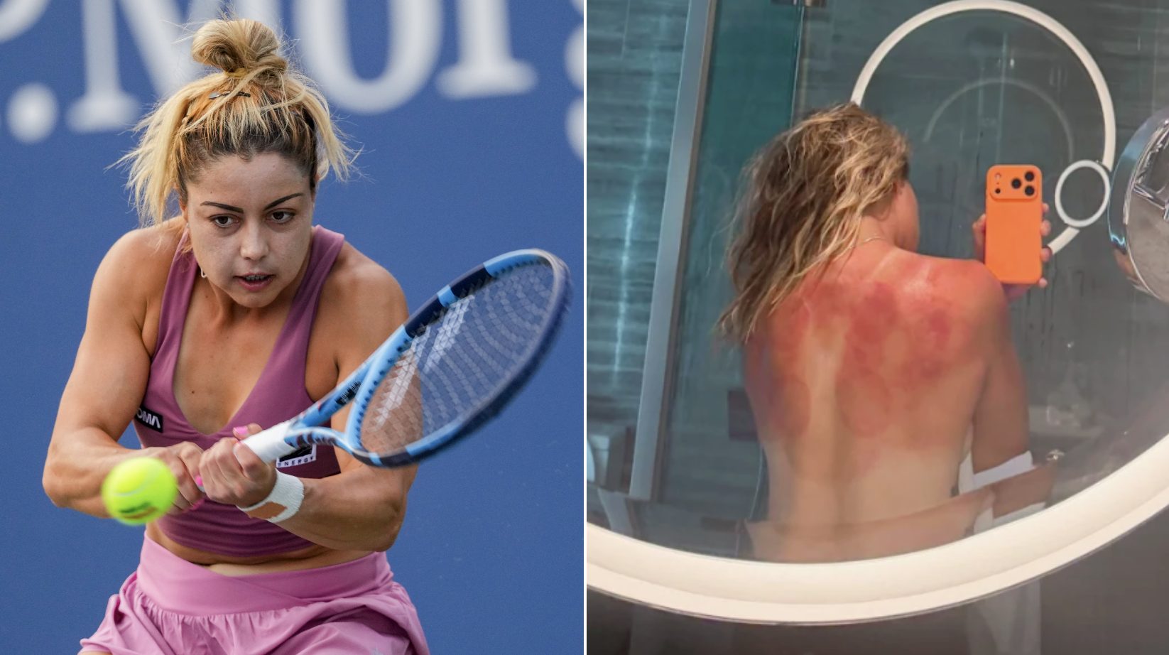 Renata Zarazua mostra gli effetti del sole sulla sua schiena martoriata prima degli Australian Open
