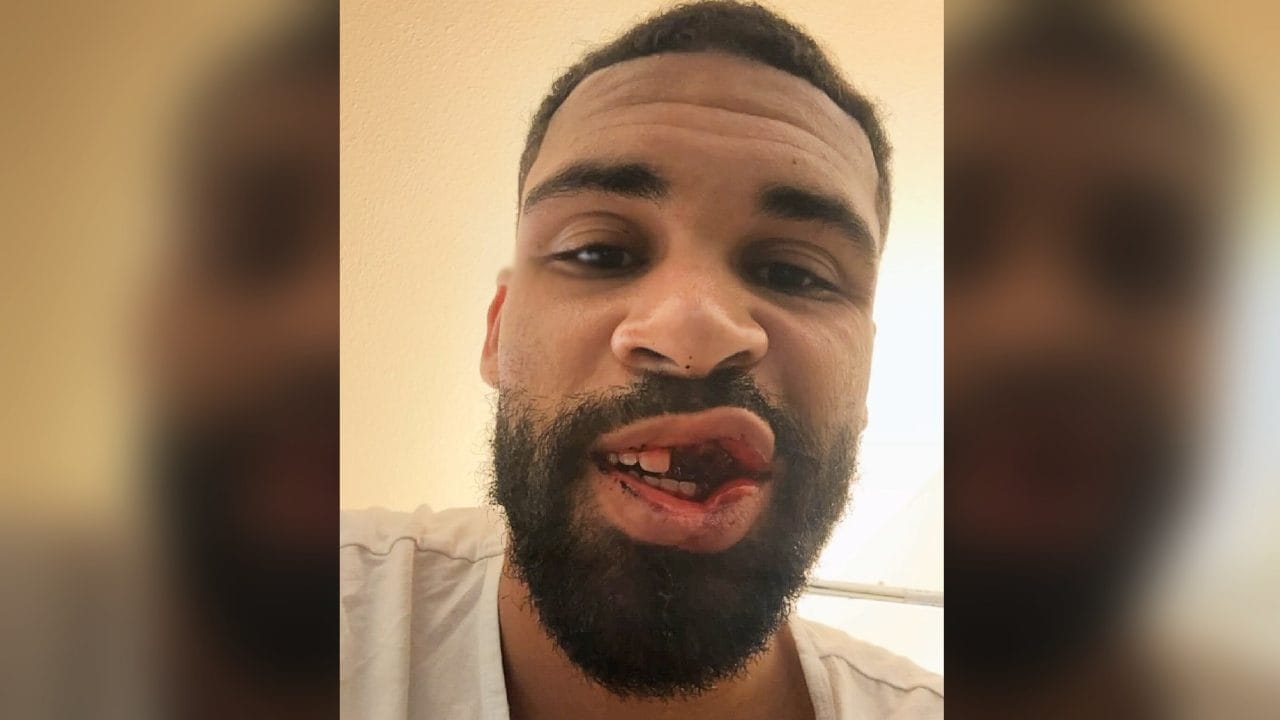 Loftus-Cheek operato per la frattura alla mascella: si aiuterà con la cannuccia, cosa potrà mangiare