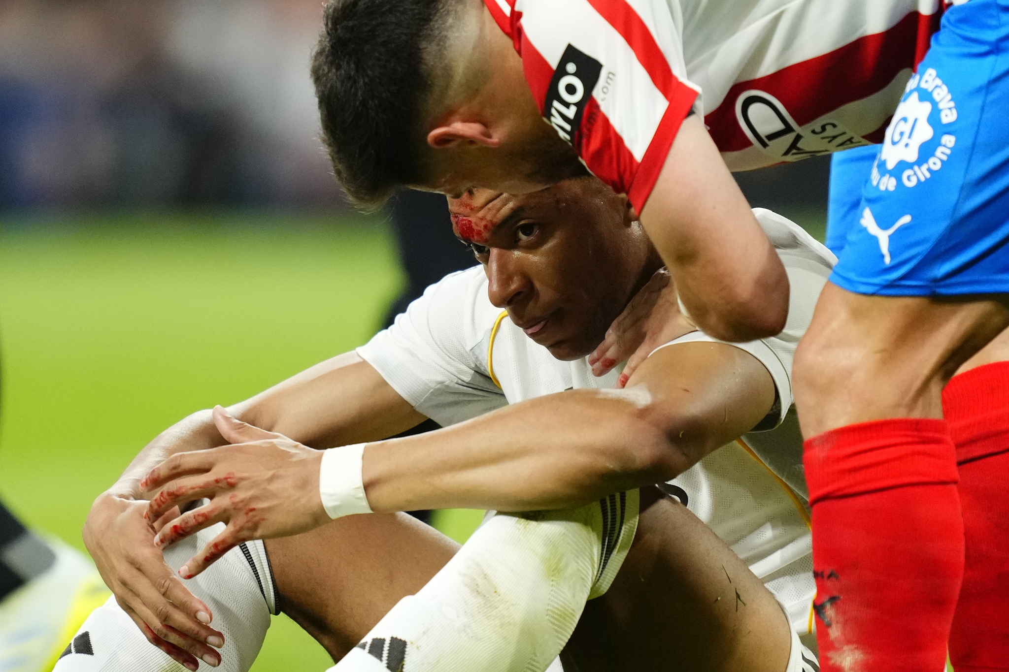 Mbappé a terra sanguinante.