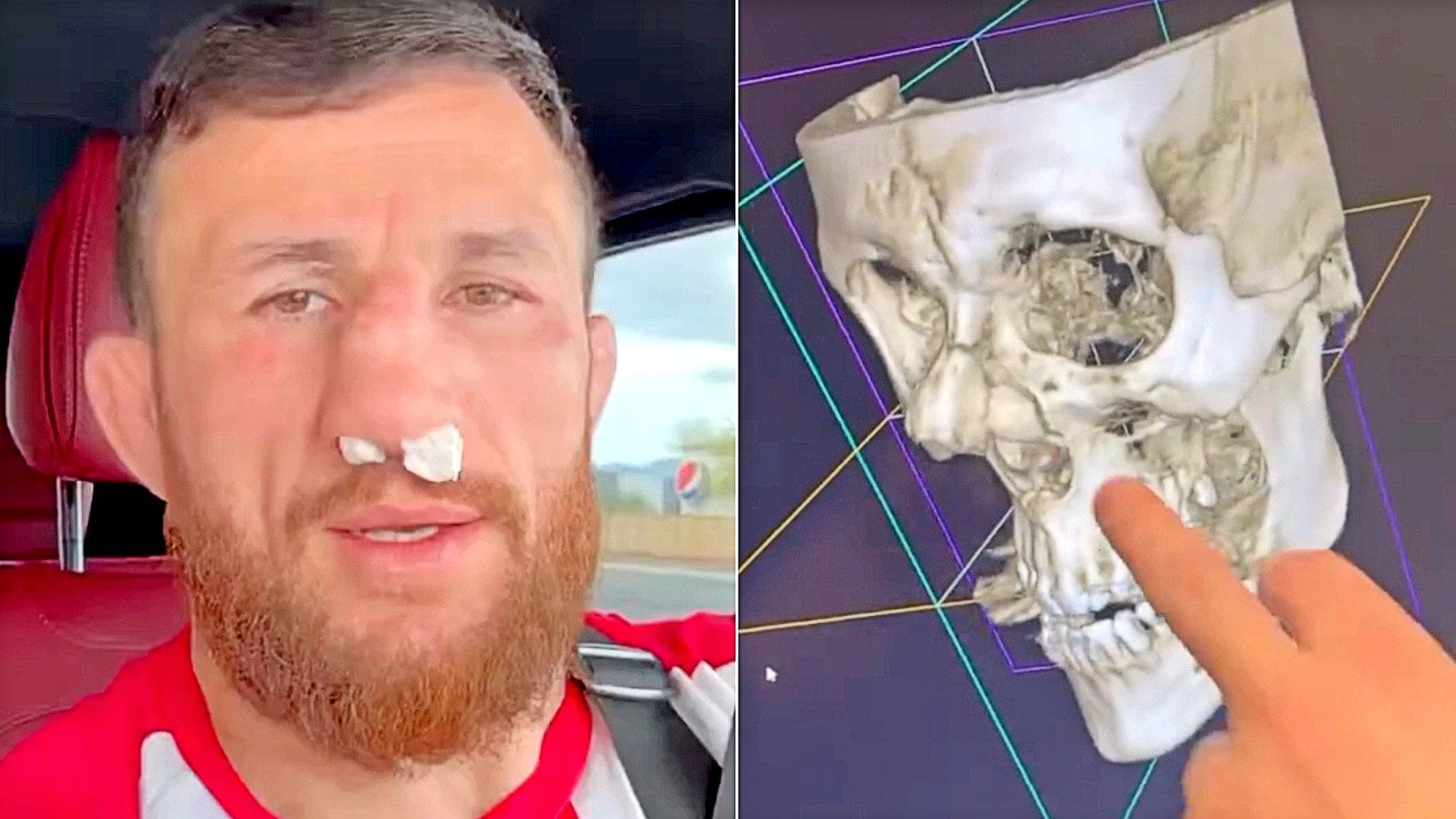 Merab Dvalishvili: "Ho il naso rotto in due punti e respiro da una sola narice. Ma non mi opero"