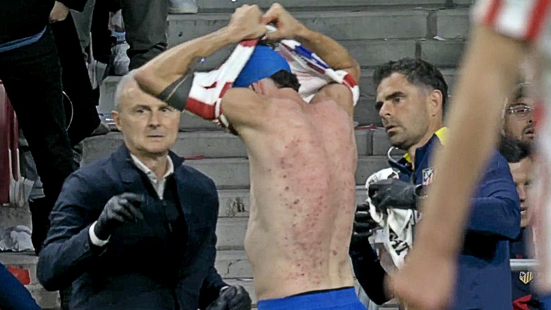 La schiena di Ruggeri ricoperta di acne in Atletico Madrid-Barcellona ha scatenato i complottisti