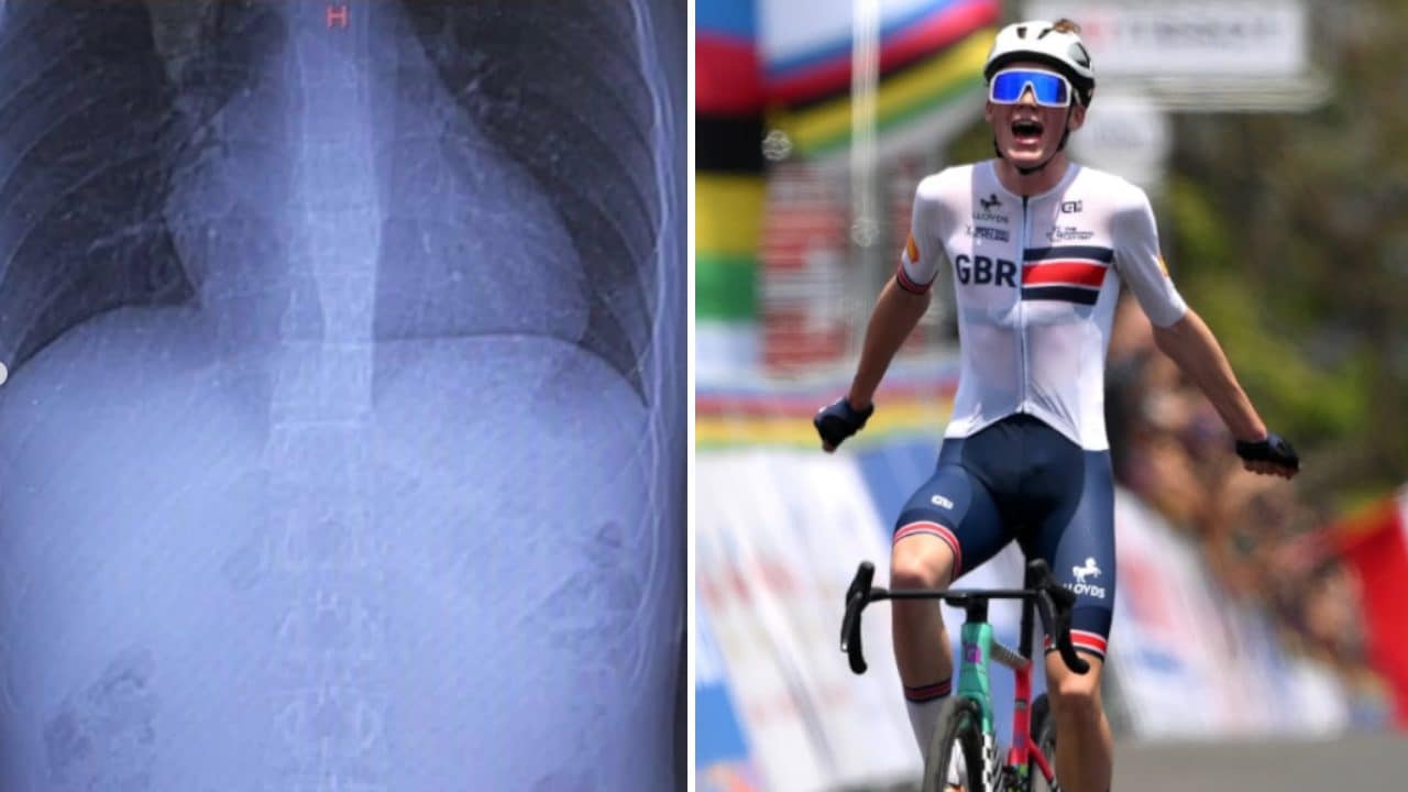 Harry Hudson investito da un motociclista contromano, frattura alle vertebre: "E' stato spaventoso"