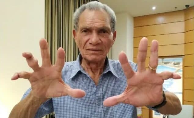 L'ex portiere brasiliano, Manga, aveva le "mani rotte".